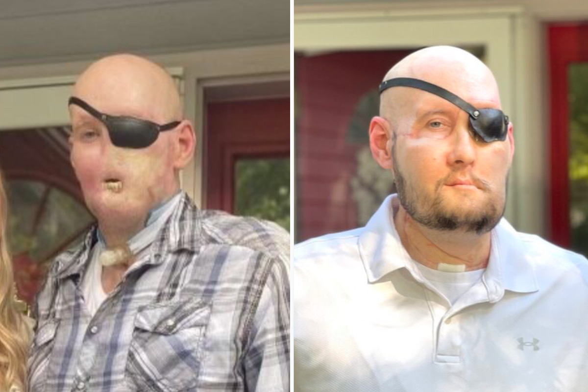 Veteran som förlorade halva sitt ansikte får världens första ögontransplantation