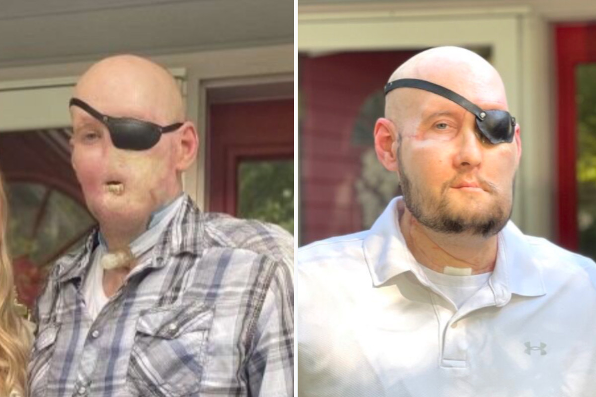 Veteran Who Lost Half of His Face Receives the World's First Eye Transplant